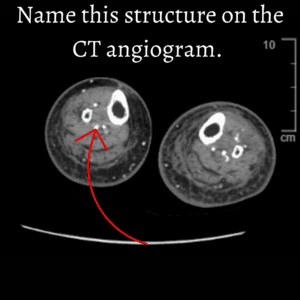 CT Angiogram