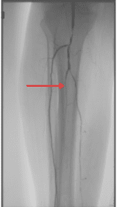 Digital subtraction angiogram