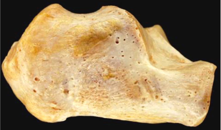 Heel Bone - Calcaneus